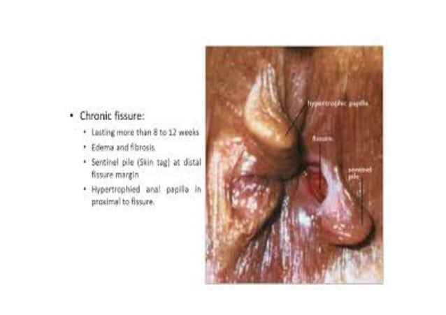 anal fissure fistula Anal fissure fistula